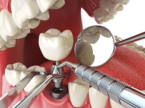 Best Urgent Care for Lost Fillings or Crowns in Houston, MS